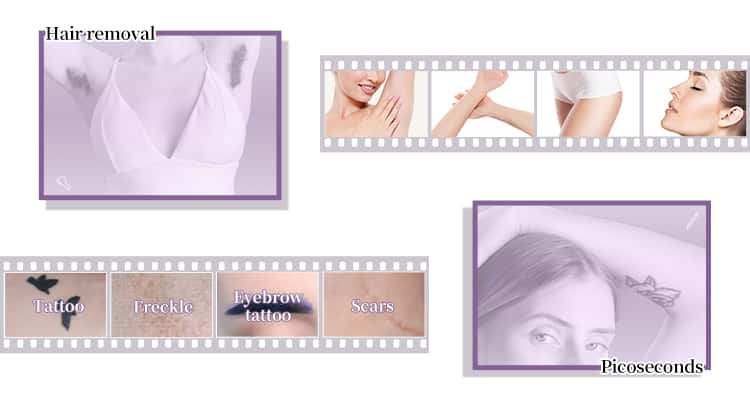 nd yag laser hair removal machine