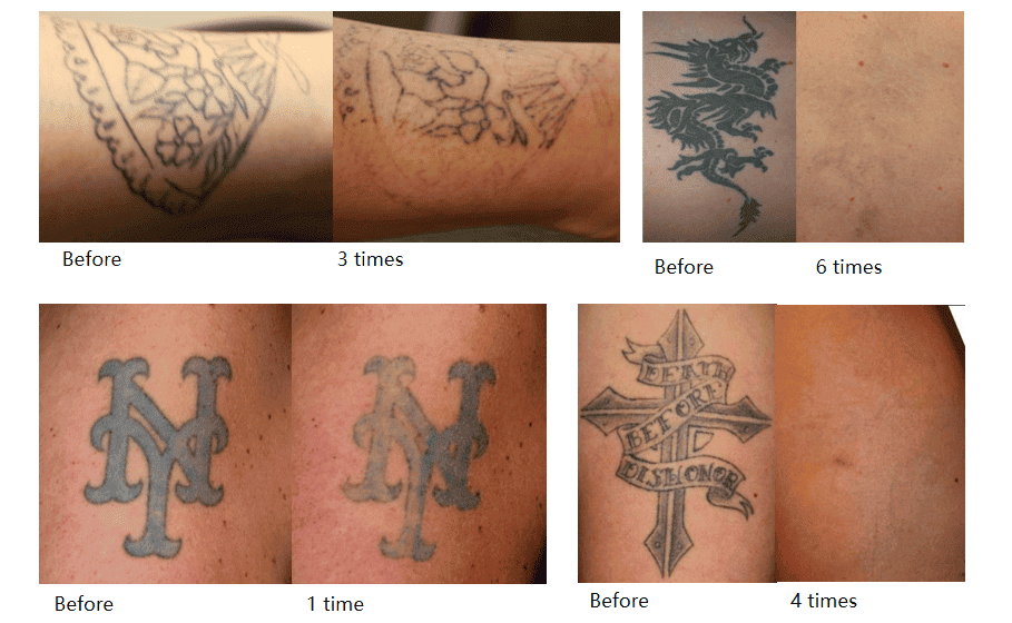 Tattoo Removal Laser Machine - Product usage effect demonstration image 4