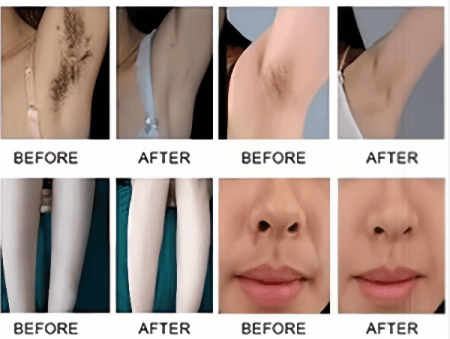 3 Waves Diode Laser Hair Removal Machine + Q-Switched ND:YAG Laser - Results Demonstration Image 1