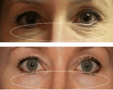 1550nm and 1927nm Dual-wavelength Fractional Laser Product Usage Effect Demonstration Image 3