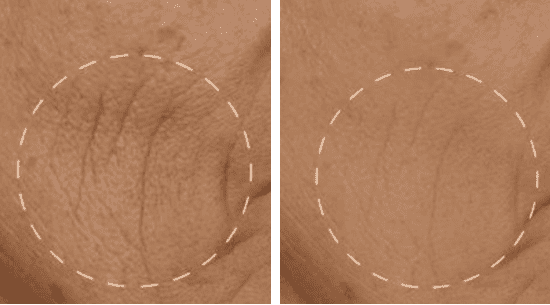 1550nm and 1927nm Dual-wavelength Fractional Laser Product Usage Effect Demonstration Image 1