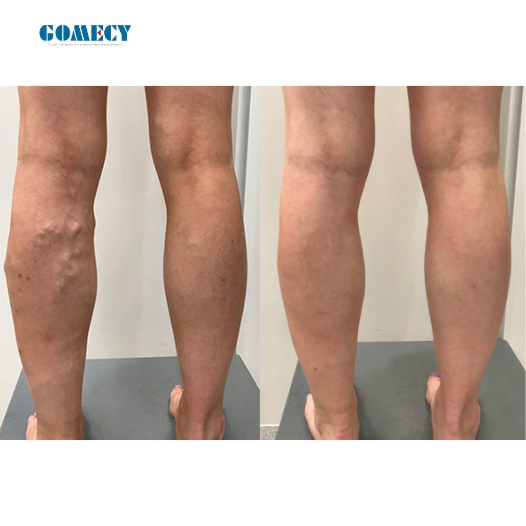 lipolysis-body-slimming-weight-loss-double-chin-shape-endolifting-laser