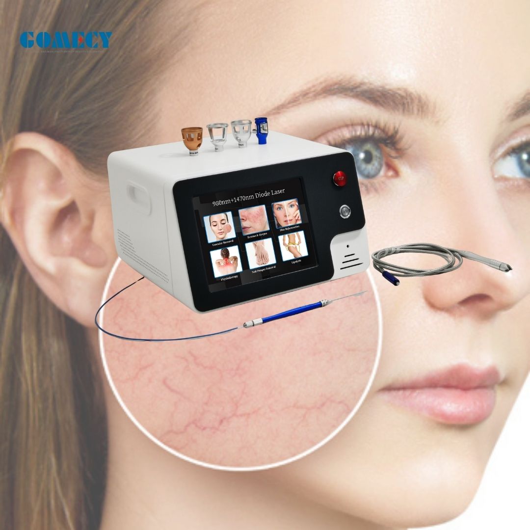 vascular-removal-laser-980nm-1470nm-veins-remove