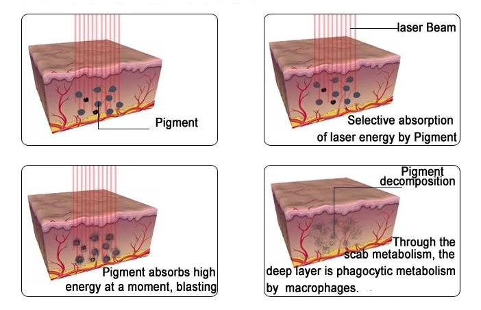 ND:YAG Picosecond Laser Machine