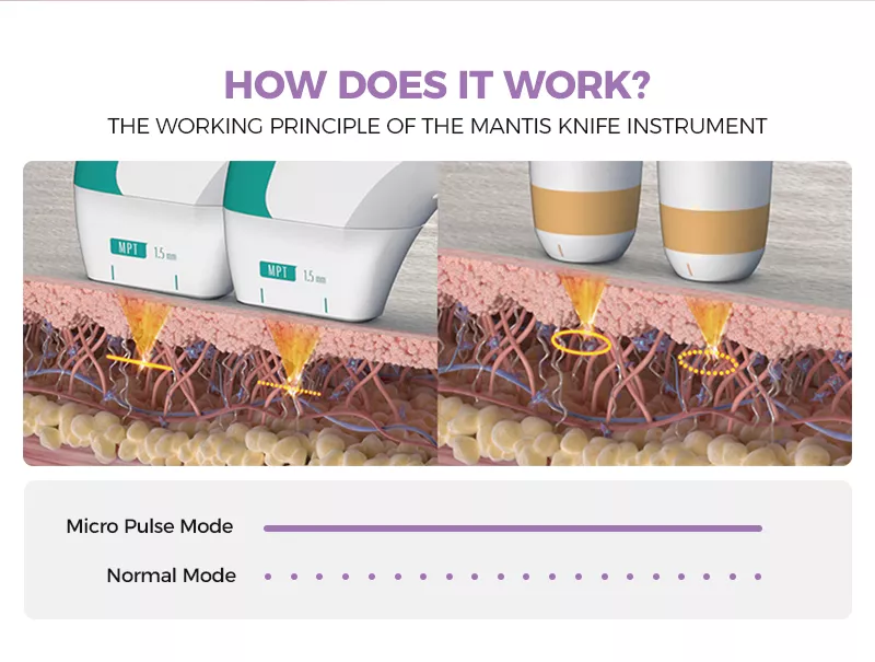 HOW DOES Ultralift HIFU WORK?