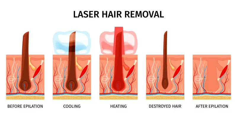 How Diode Laser Hair Removal Works