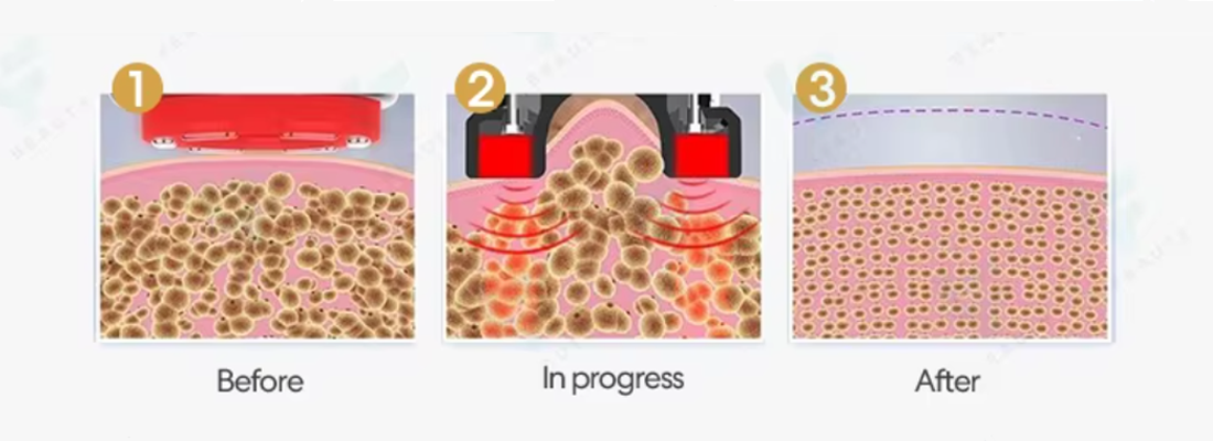 Vacuum Suction + RF Technology