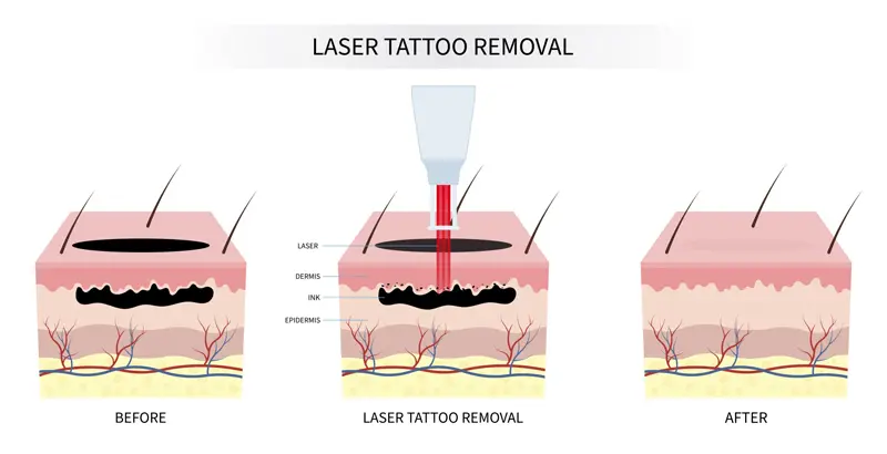 How does ND YAG LASER Works?