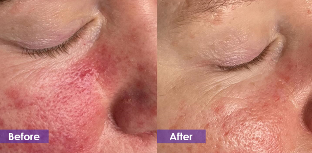 redness removal before and after