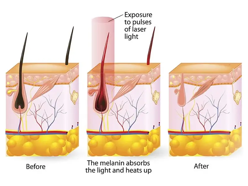 Diode laser hair reduction machine Working Principle