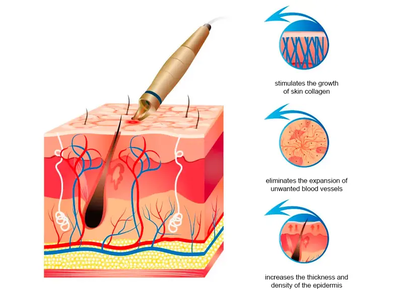 How 980nm laser work?