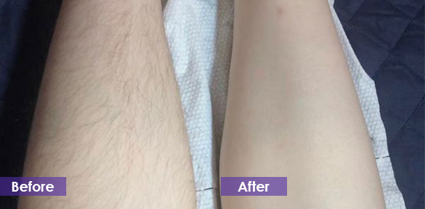 diode laser Leg hair removal
