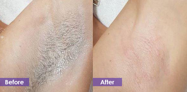 diode laser Underarm hair removal