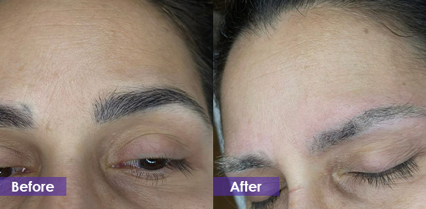 Eyebrow Tattoo Removal before and after
