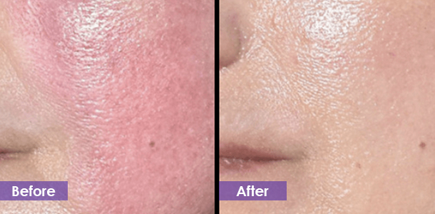 Facial redness removal before and after