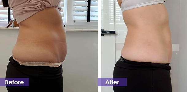 fat reduction before and after