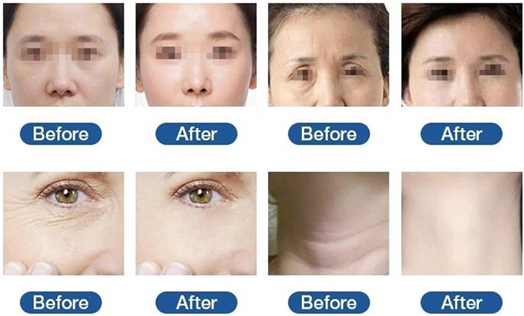 Multi-Functional HIFU Device Before and After