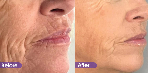 Eliminación de arrugas de labios y efecto de tratamiento reafirmante.