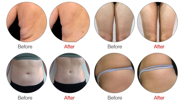 Mini EMS Body Sculpt Machine Before & After