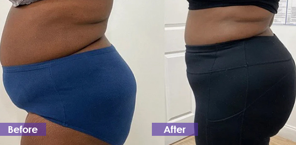 Abdominal Tightening before and after