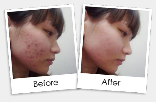 Face Acne Treatment