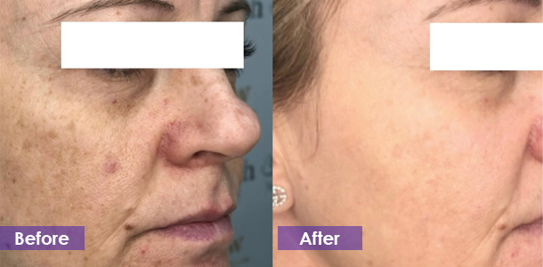 RF Microneedling for acne treatment treatment result