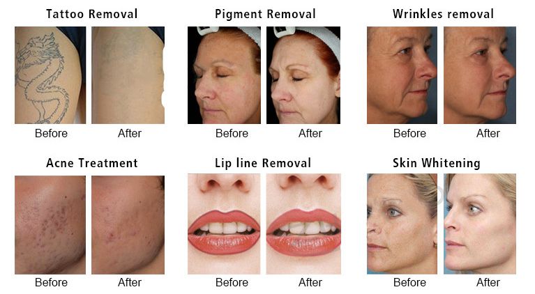 pico laser treatment before and after