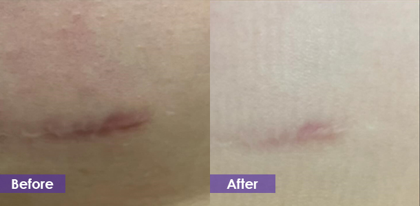 Microneedle RF to reduce scars before and after