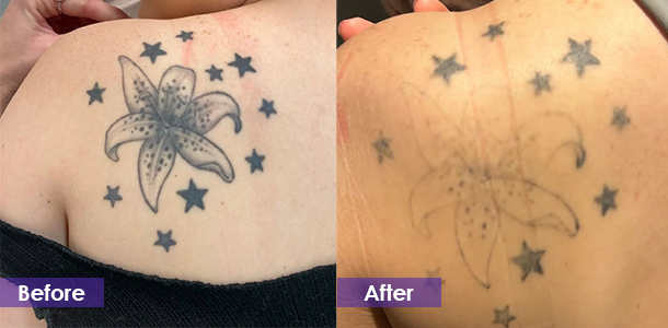 Tattoo Removal Treatment effect
