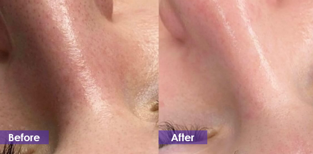IPL Skin Resurfacing