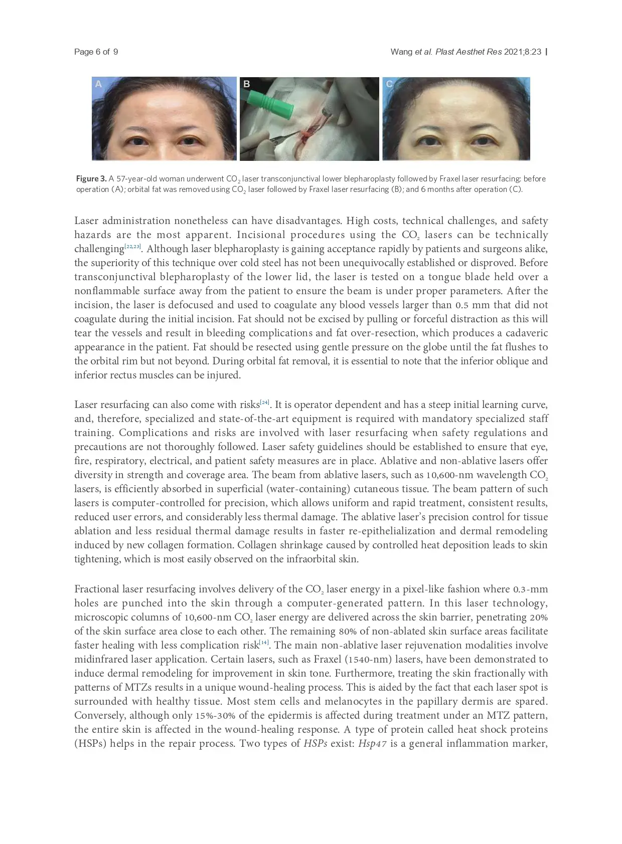 Fractional CO2 laser vs. Fraxel laser for lower eyelid rejuvenation following transconjunctival lower blepharoplasty