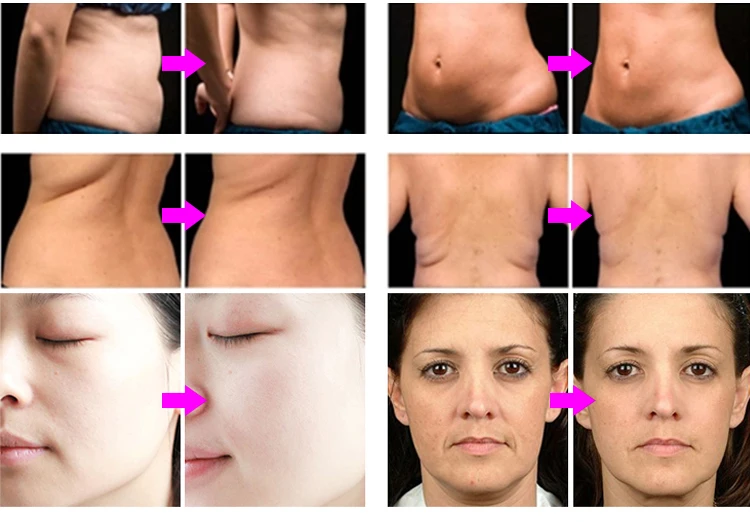 Portable BTL Before & After