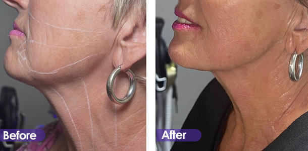 Face lifting and firming before and after