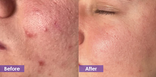 Clean pores and remove acne before and after