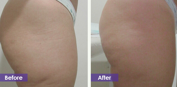 Buttocks firming before and after