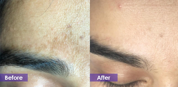Pigmentation removal before and after