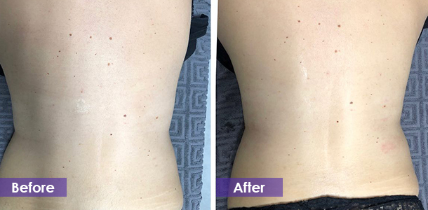 Waist tightening before and after