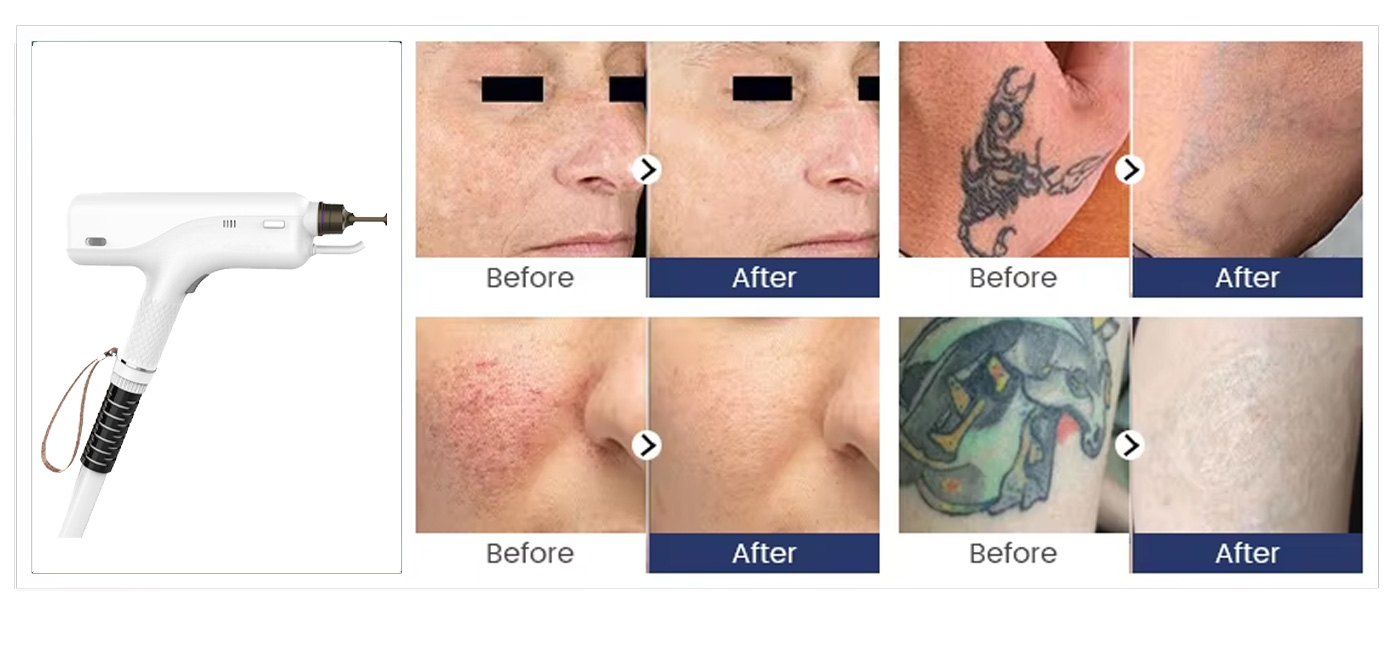 Before and after photos of tattoo removal