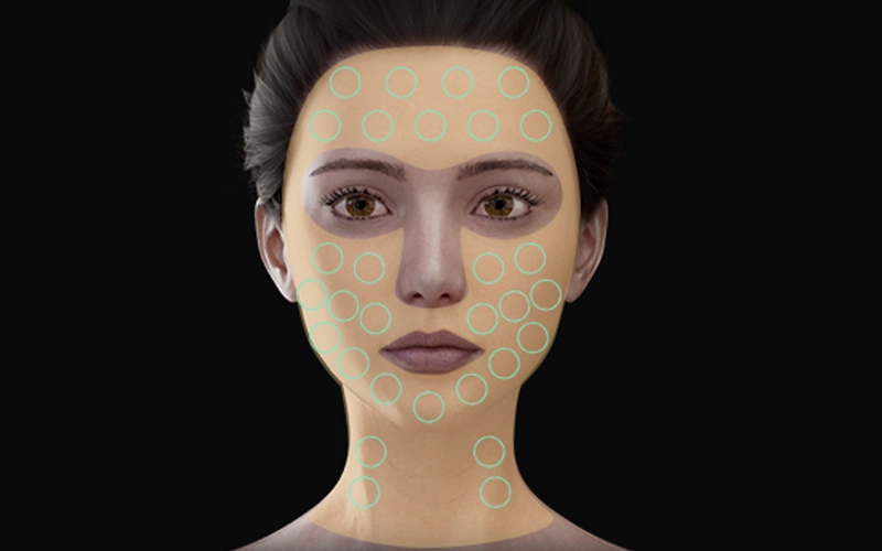 360 MAX HIFU Micro-pulse treatment
