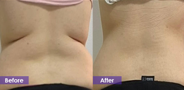Waist tightening before and after
