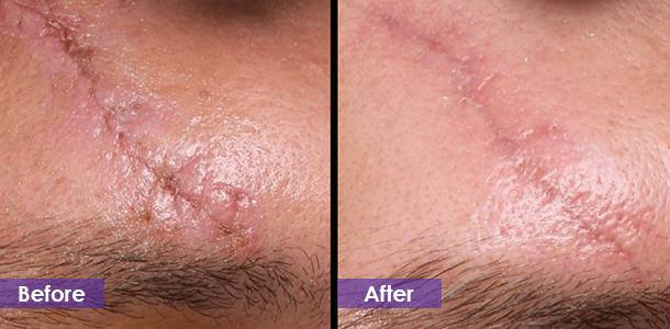 RF Microneedling to reduce scars treatment result