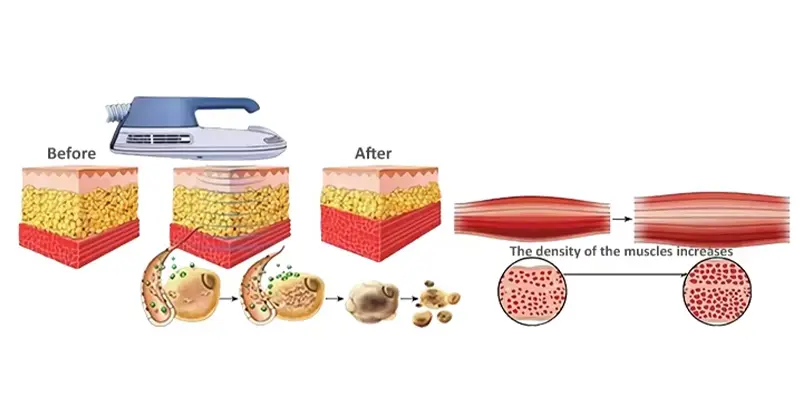How does the emslim machine work?
