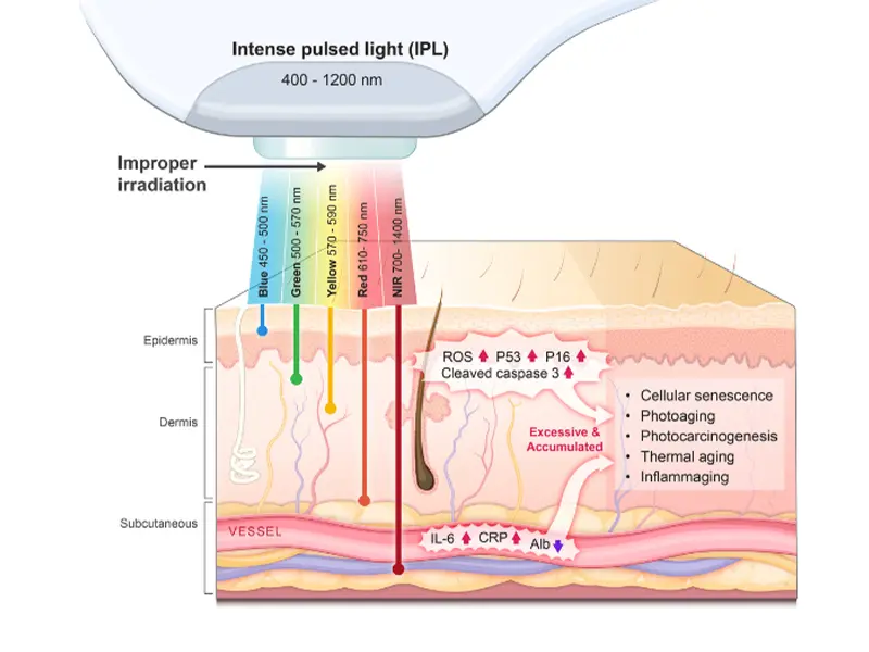 How does IPL treatment work?