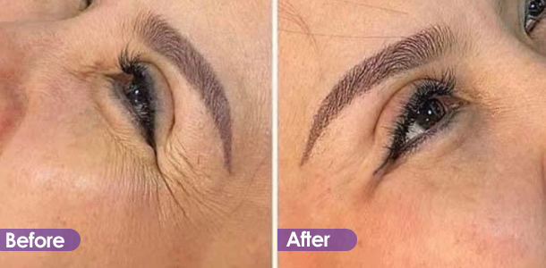 Anti-wrinkle and firming around eyes