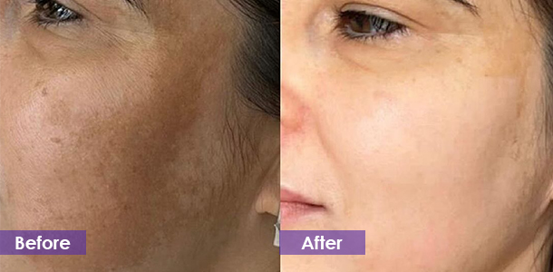 Pico laser pigmentation removal before and after