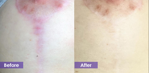 CO2 laser scar reduction treatment result