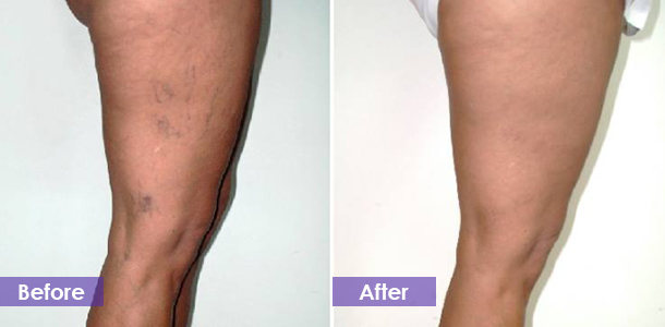 Varicose vein removal on the legs before and after