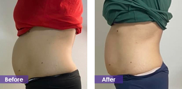 Abdominal fat reduction before and after