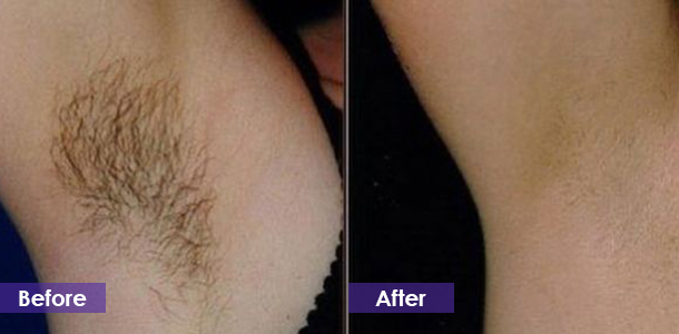 arm hair removal