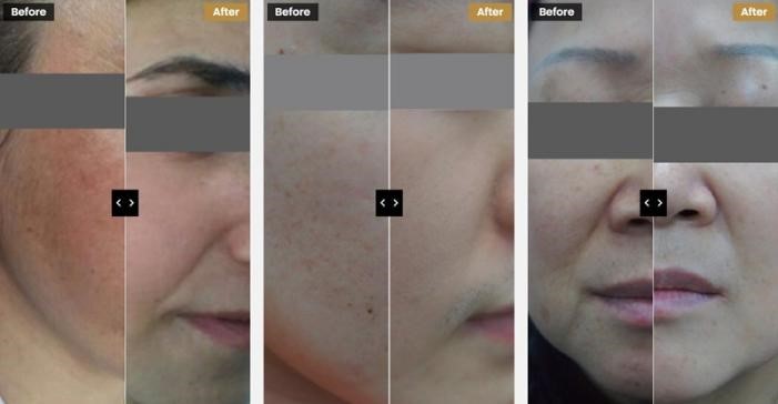 Before and after photos of freckle removal treatment